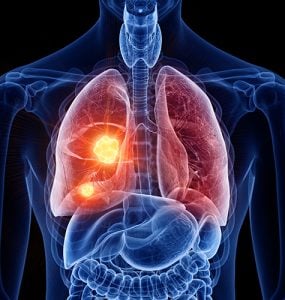 What is Popcorn Lung and is it Caused by Vaping