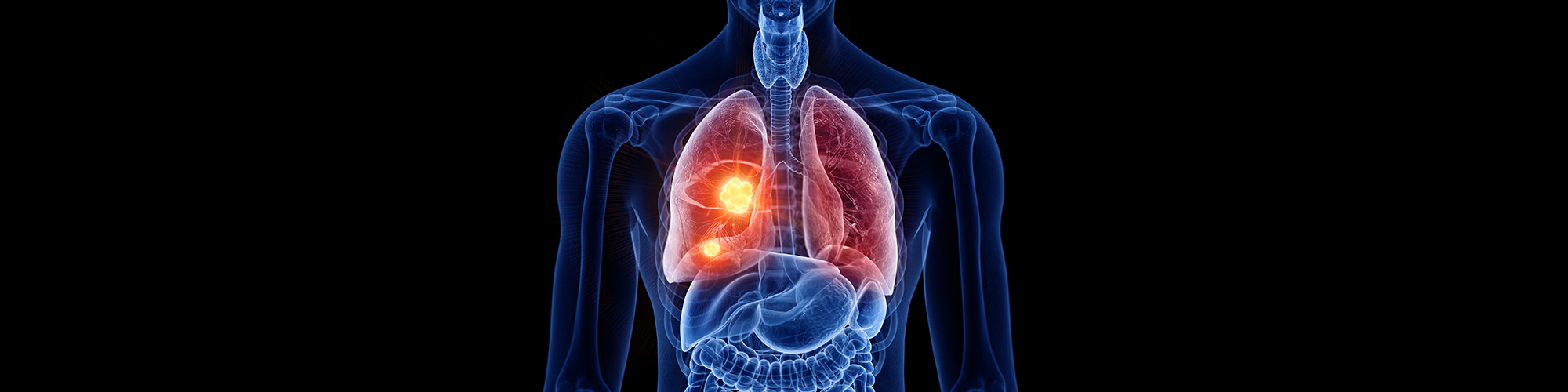 What is Popcorn Lung and is it Caused by Vaping